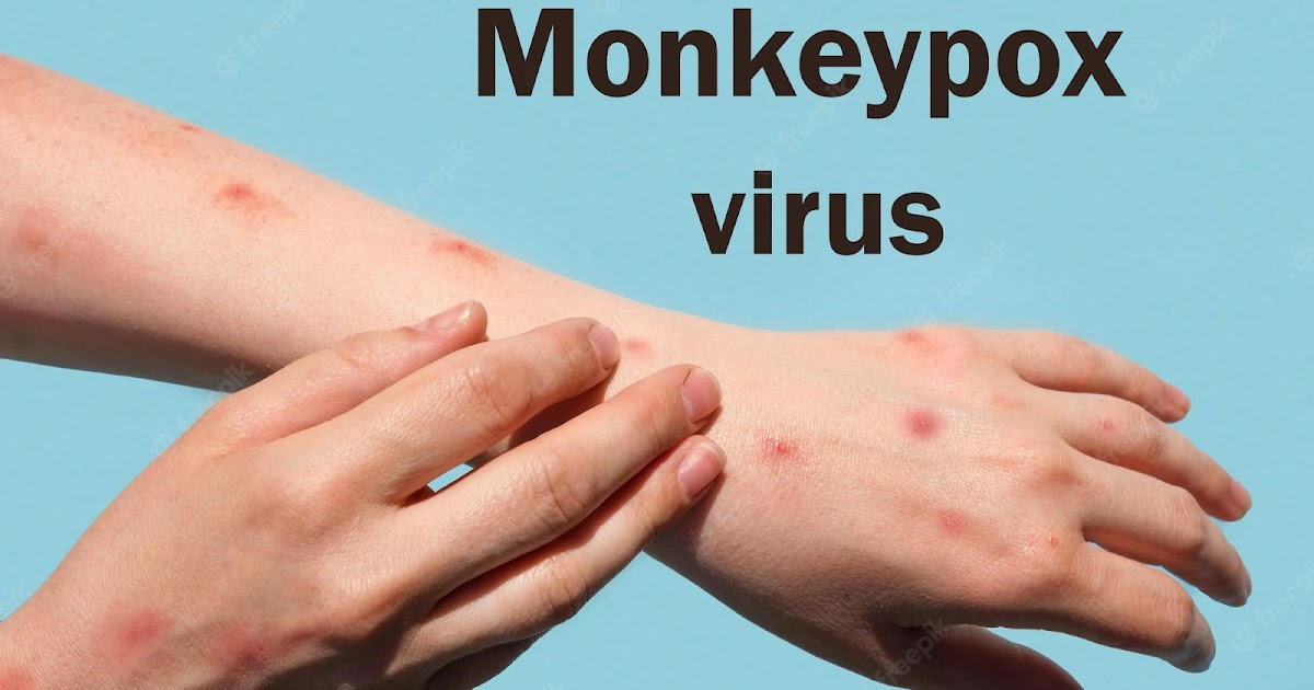 Monkeypox: Symptoms & Spread